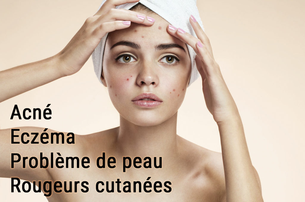 psoriasis acné boutons et naturopathie